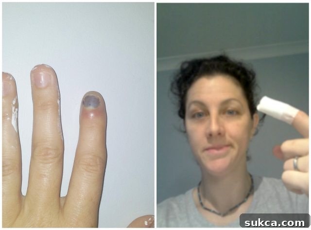 DIY woodworking injury: Kristy's smashed finger from a hammer, highlighting the importance of workshop safety - SawdustGirl.com